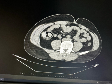 Midelerinde uyuşturucu çıkan 2 şüpheli, tutuklandı