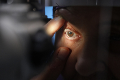 Görme kaybı yaşayan hasta, tedaviyle sağlığına kavuştu