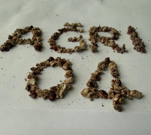 Daha önce 21 kez böbrek taşı operasyonu geçiren hastadan 295 taş çıkarıldı