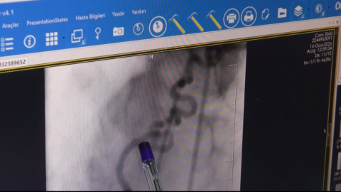 Hastanın kalbine giden kanı akciğere yönlendiren ‘anormal damar‘ operasyonla kapatıldı